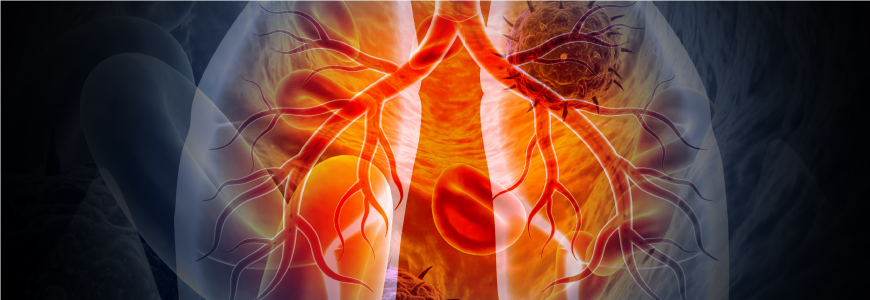 Medical Illustration showing lung cancer or bronchial carcinoma on medical background