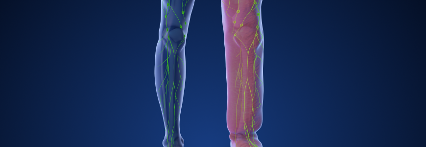 Medical animation depicting limb lymphedema
