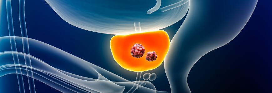 Prostate cancer with organs and tumor or cancerous cells 3D rendering illustration