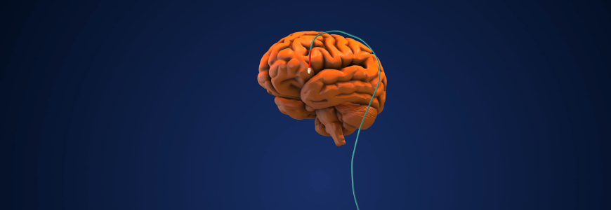 Deep brain stimulation as a medical concept