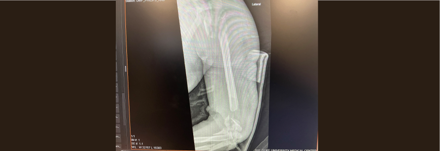 Radiograph of elbow graft
