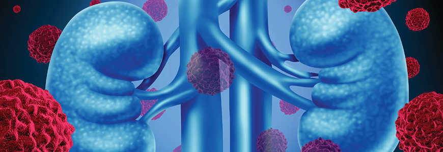 Kidney cancer medical concept as cancerouse cells in a human body attacking the urinary system and renal anatomy as a symbol for tumor growth treatment and risk.