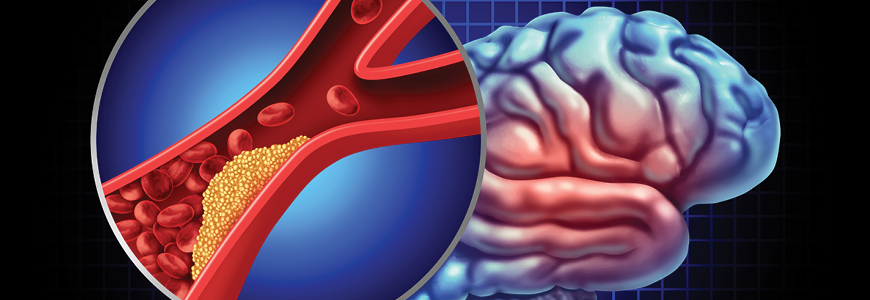 Transient Ischemic Attack or TIA or Ministroke medical condition as a stroke with blood flow in the brain blocked in an artery by plaque or blood clot buildup as Atherosclerosis or Emboli.