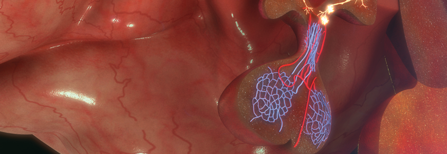 GnRH is an acronym for gonadotropin-releasing hormone. This hormone is released by the hypothalamus in the brain.
