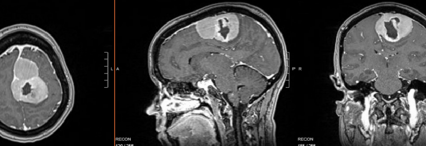 MRI of meningioma preop