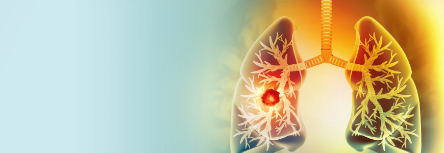 Medically accurate illustration of lung cancer. showing presence of cancerous tumor inside the lungs