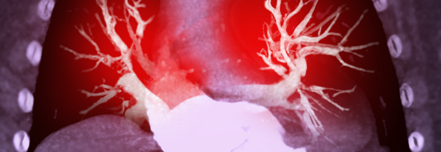 CTA Chest or CTPA with contrast media 3D rendering for diagnostic Pulmonary embolism (PE)