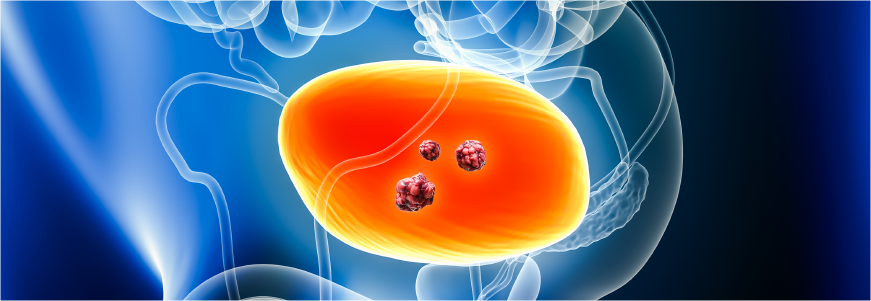 Anatomic graphic showing cancerous cells in the bladder