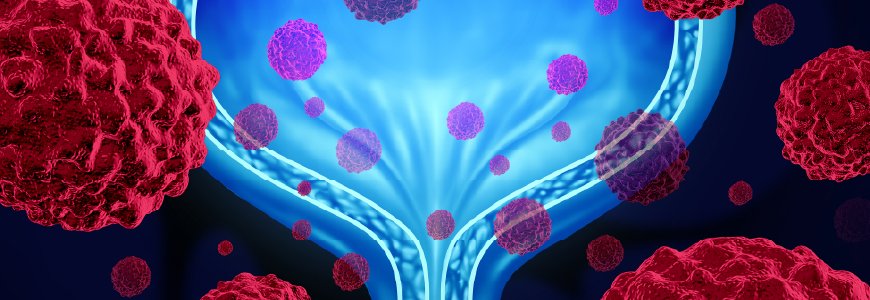 Bladder cancer medical concept as a urinary anatomical organ symbol with microscopic cancerous malignant cells spreading in the human body as a healthcare 3D illustration.