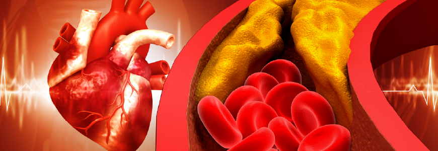 Blood vessel blockage, Heart attack, coronary artery disease and atherosclerosis condition. 3d illustration