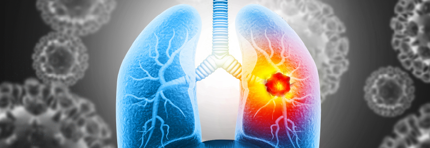 Medical Illustration showing lung cancer or bronchial carcinoma