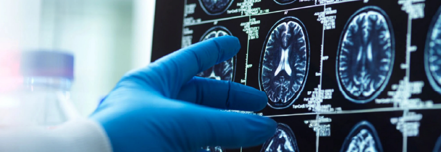 A doctor's hand in a surgical glove pointing at a brain scan image on a computer screen