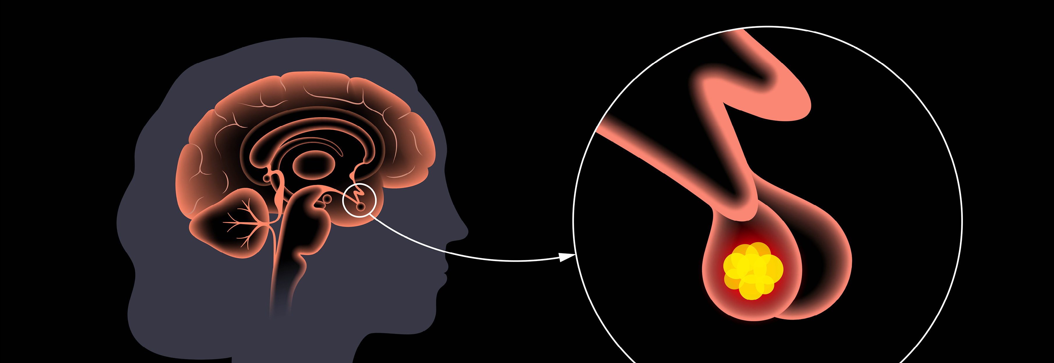 Tumor in the human brain