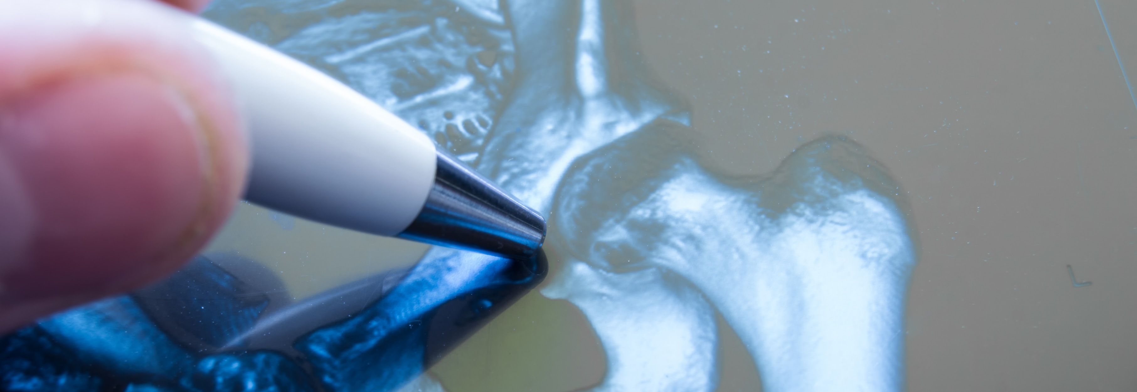 Doctor pointed on area of hip joint, where pathology is detected