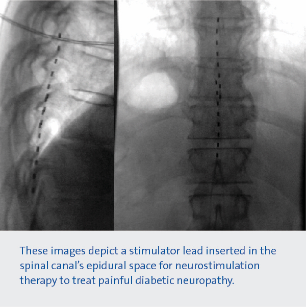 Images depict a stimulator lead inserted in the spinal canal's epidural space for neurostimulation therapy