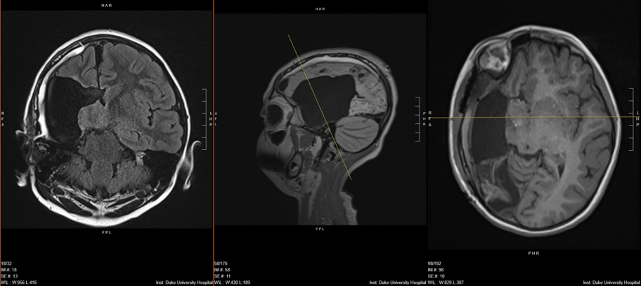 MRI of patient's brain after surgery – coronal, axial and sagittal