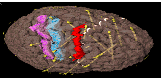 Brain imaging showing motor and sensory areas of the brain affected, causing epilepsy