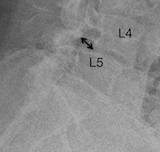 shifted L4 vertebral body