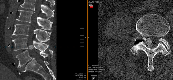 Imaging showing large spinal cyst occluding the L4-5 epidural space