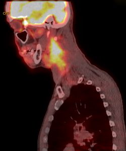 Cancers That Show Up On CT Scans