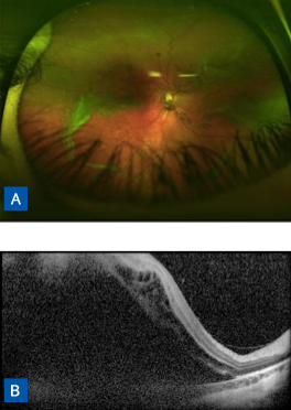 retinal detachment vision