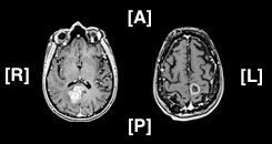 Patient With “Inoperable” Brain Metastases Seeks Second Opinion