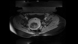 FIGURE 1b. Example MRI after treatment with MRgFUS.