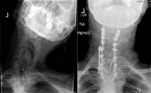 Figure 1. X-ray images of the patient’s neck before (left) and after (right) corrective surgery.