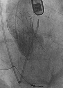 Radiographic angiogram 