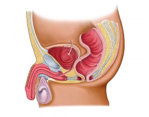 How Prostate Cancer Is Treated