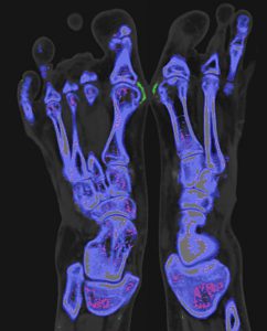 Corticosteroids,-NSAIDs-Yield-No-Difference-in-Gout-Outcomes