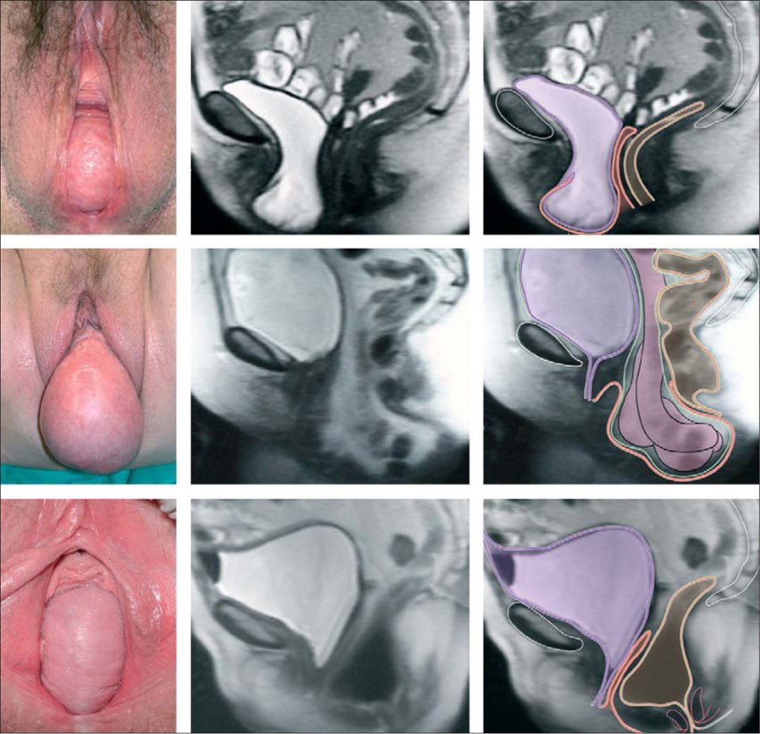 Pros & Cons of Pelvic Prolapse Surgery