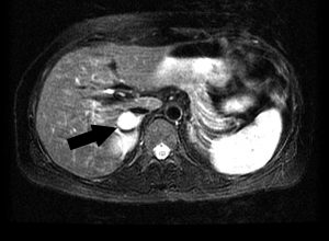 Magnetic resonance imaging (MRI) of an adrenal pheochromocytoma (arrow). This tumor produces catecholamines that may cause high blood pressure. A pheochromocytoma or phaeochromocytoma (PCC) is a neuroendocrine tumor of the medulla of the adrenal glands (originating in the chromaffin cells), or extra-adrenal chromaffin tissue that failed to involute after birth and secretes high amounts of catecholamines, mostly epinephrine, plus norepinephrine to a lesser extent.