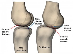 bone bruising around the knee