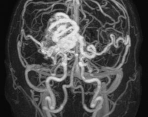 Brain arteriovenous malformation (AVM). Magnetic resonance angiography (MRA) scan of the brain of a 31 year old man (front view). The image shows a right thalamic AVM (white), a congenital malformation of the blood vessels (arteries and veins) that can rupture and bleed inside of the head and cause seizures, headaches, stroke-like symptoms, and other fatal complications. MRA is a non-invasive technique to image blood vessels in the body that uses a combination of a very strong magnetic field and radiofrequency (RF) pulses to image the flowing blood.