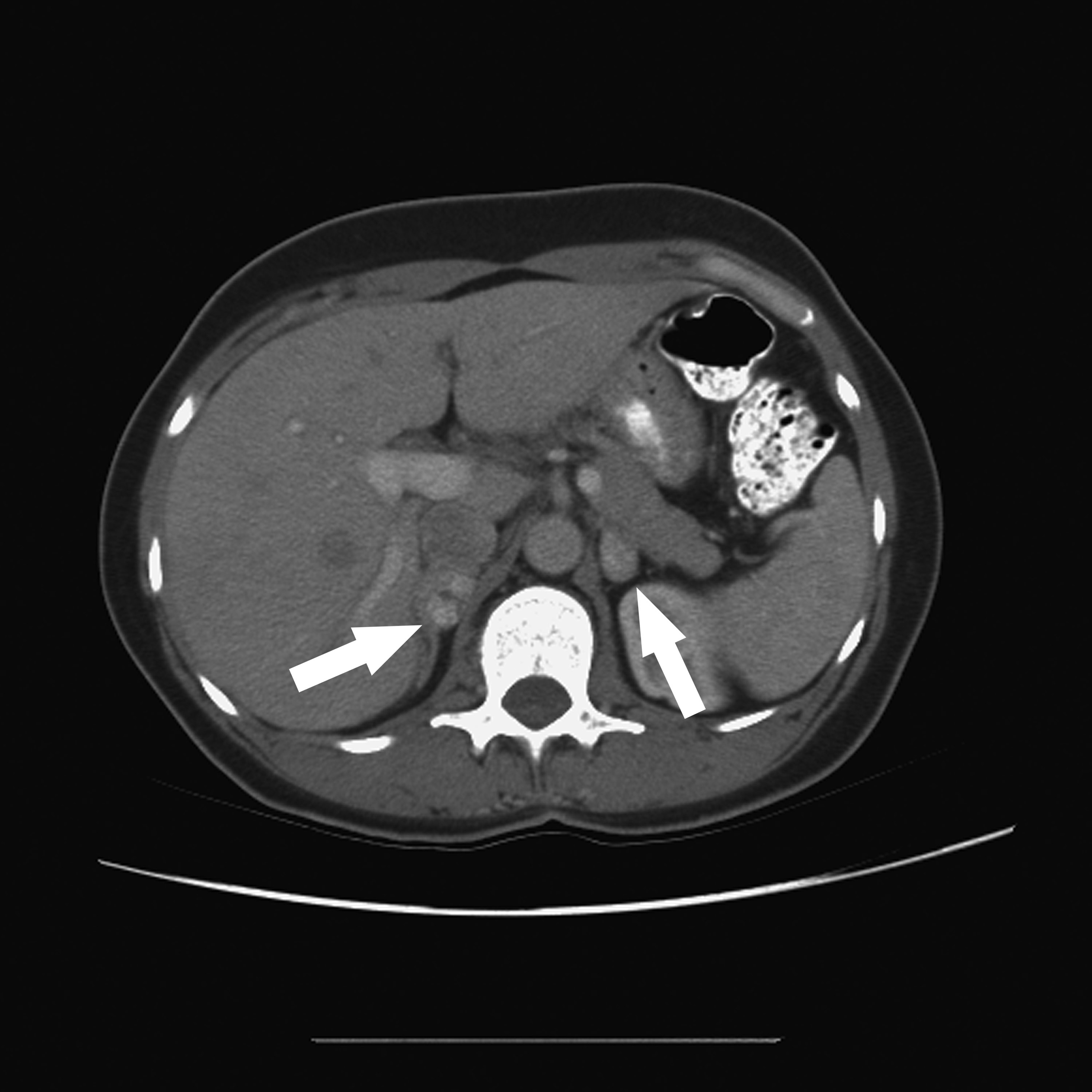 Computed tomography (CT) scan with contrast media of bilateral pheochromocytomas (arrows). This patient has von Hippel-Lindau syndrome. A pheochromocytoma or phaeochromocytoma (PCC) is a neuroendocrine tumor of the medulla of the adrenal glands (originating in the chromaffin cells), or extra-adrenal chromaffin tissue that failed to involute after birth and secretes high amounts of catecholamines, mostly epinephrine, plus norepinephrine to a lesser extent. Von Hippel-Lindau disease (VHL) is a disease which results from a mutation in the von Hippel-Lindau tumor suppressor gene on chromosome 3p25.3