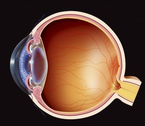 Glaucoma, drawing. Angle-closure glaucoma Illustration of angle-closure glaucoma: the trabecular meshwork is blocked by the pupil, preventing the aqueous humor from draining properly. This causes an acute rise in intraocular pressure, deformation of the optic nerve head, and eventual destruction of the optic nerve.