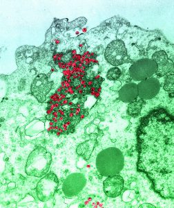 Ultra thin section of Human T-lymphocyte showing aggregates of HIV particles in the cytoplasm, buddings and two extracellular HIV particles. The human immunodeficiency virus (HIV) is responsible for acquired immune deficiency syndrome or AIDS. The virus permits opportunistic infections, malignancies, and neurologic disease. The immunologic defect is due to the effect the virus has in making T4 lymphocytes ineffective; in addition the virus can injure the cells of the nervous system. After the initial infection the patient may be an asymptomatic carrier for years. Most cases of AIDS have developed after sexual contact with an infected person. The virus is also spread via tears of saliva into blood or from blood into blood, by transfusion of infected blood, contaminated hypodermic needles, or transplacentally from an infected mother. AIDS is a fatal disease for which there is currently no existing cure. TEM Magnification = x7,500 at 2.25 film size.