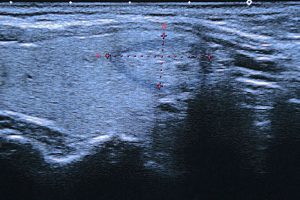 Ultrasound showing a nodular tumor in the thyroid gland.