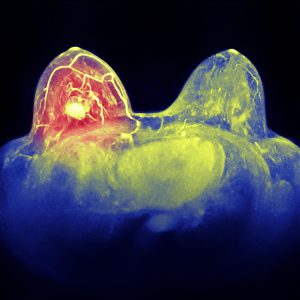 Breast cancer. Colored X-ray of the breasts of a woman with breast cancer. There is a malignant (cancerous) tumor (solid yellow mass) in the left breast (red). Breast cancer is the most common type of cancer in women. The cancer can invade surrounding tissue and spread to other parts of the body (metastasis). Treatment is with removal of the tumor only, where possible, or complete removal of the breast. Surgery is often combined with radiation therapy and chemotherapy.