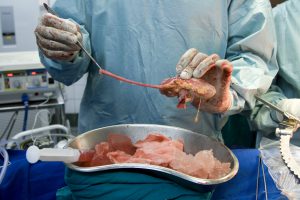 First Nigerian pediatric living kidney transplant. Surgeon holding a kidney from a living donor. This is during an operation on a thirteen-year-old boy who is the first ever pediatric patient to receive a living Kidney transplant in Nigeria. This kidney is from his older brother. The surgery was overseen by an experienced UK surgeon and nephrologist who traveled to the country to give help and advice. Photographed in Lagos, Nigeria, in 2009.