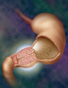 Pyloric stenosis.