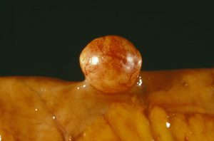 Intestinal fat tumour. Gross specimen of a lipoma (round lump) in the small intestine. A lipoma is a tumour that forms from fat cells. Lipomas are most common in the skin, and are rare in the intestinal tract. The growth of the tumour can obstruct the intestine, requiring the surgical removal of the tumour. In rare cases a lipoma may turn cancerous, when it is termed a liposarcoma.