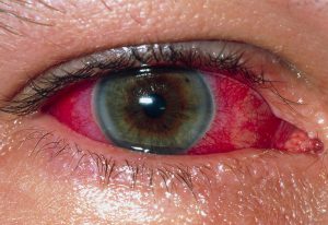 Uveitis. Close-up of the eye of a 43 year old man showing uveitis. It has caused the sclera (white of the eye) to become severely bloodshot. Uveitis is any inflammation of the uvea of the eye, which includes the iris (colored part),  the lens muscles and the blood vessels which supply the retina. This condition may be caused by an infection,  although it is usually an autoimmune disorder, in which the body turns its defenses against  itself.  Treatment  involves  taking corticosteroid drugs to reduce inflammation, and using eye drops containing atropine to block nerve impulses to the iris muscles.
