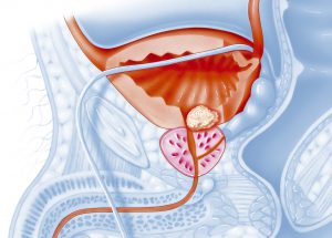 Illustration of cancer of the prostate.