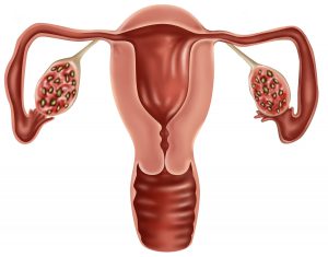 Illustration of polycystic ovaries. Ovarian cysts are collections of fluid surrounded by very thin walls within an ovary. There are many kinds, most of them benign.