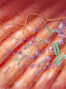 Editorial medical illustration showing healthy, innervated muscle fibers on the upper right and disruption of the muscle fiber sarcomeres (Z disc, I band, H zone, A band, and M line) due to a muscle disorder. Blood is present in the affected areas. Various antibodies and leukocytes (monocytes, neutrophils, macrophages) are also shown conceptually flying in due to an inflammatory response.