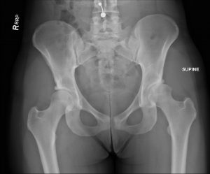 FIGURE 1. Preoperative radiography of the anteroposterior pelvis revealing significant joint space, narrowing with 0.5 mm of superior joint space. Findings are consistent with arthritis resulting from underlying hip dysplasia. Lucency along the posterior acetabulum represents the fracture