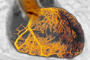 Myocardial infarction due to stenosis of the left coronary artery. Coronarography in frontal view.