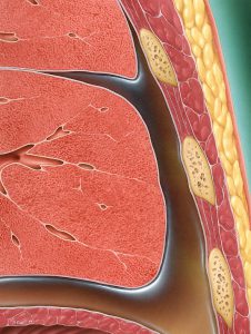 Pleural Effusion